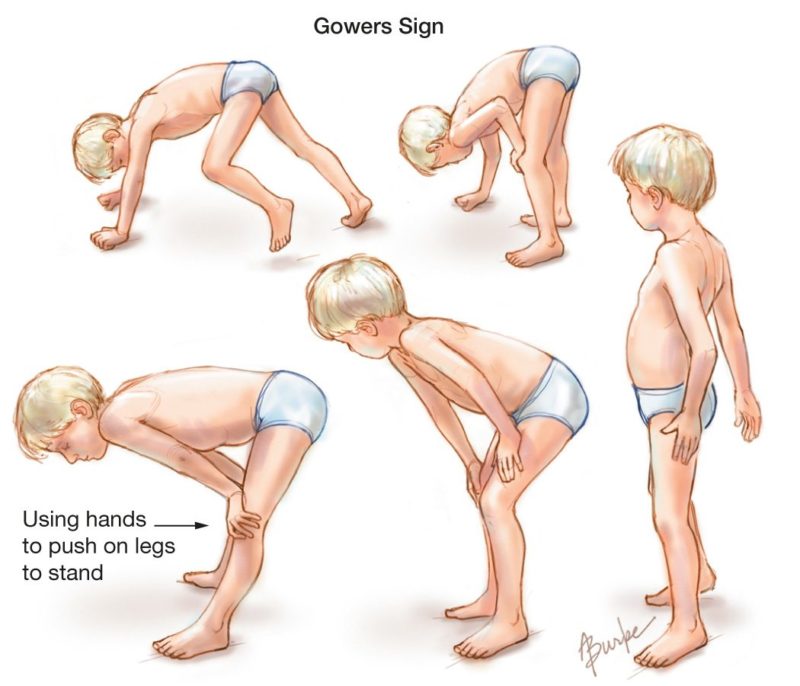 muscular dystrophy 800x686 1